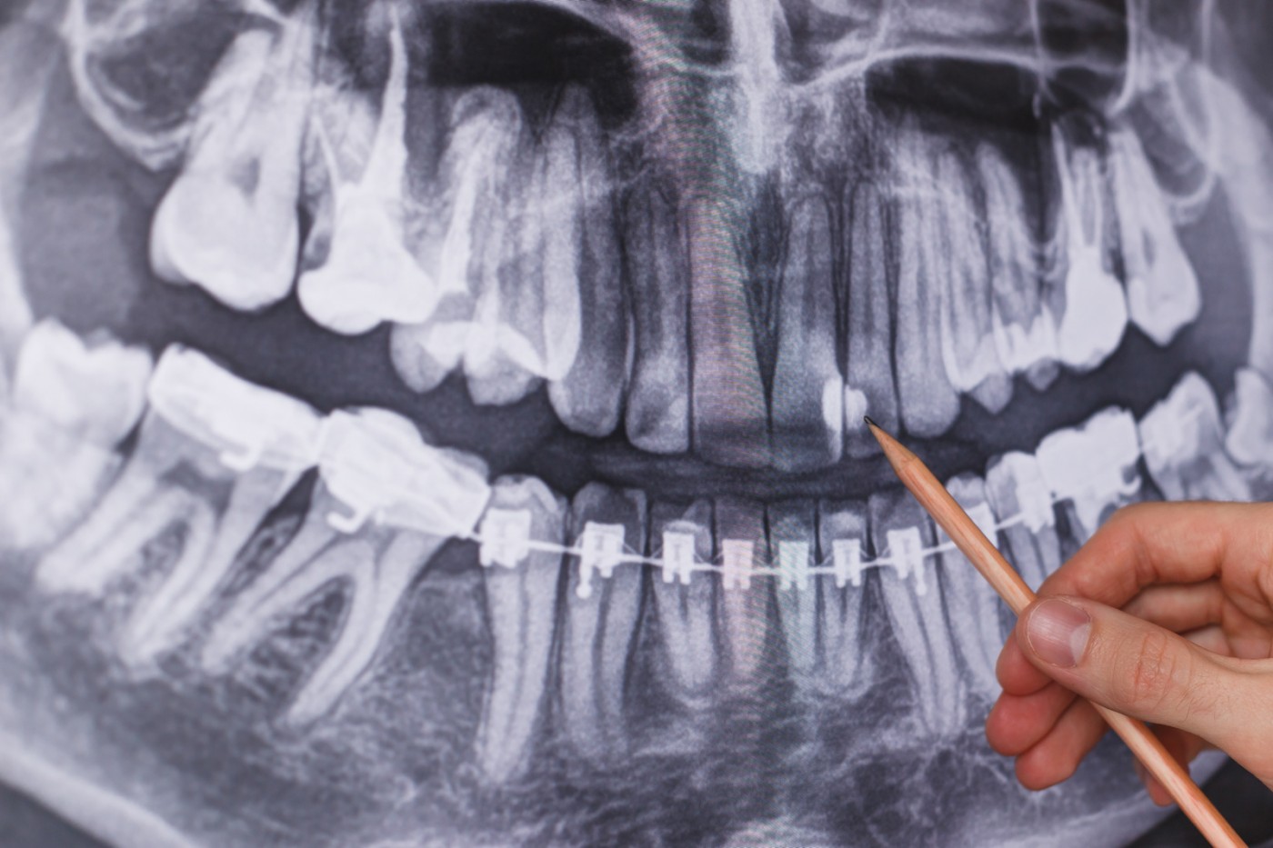 Tratamentul ortodontic corect