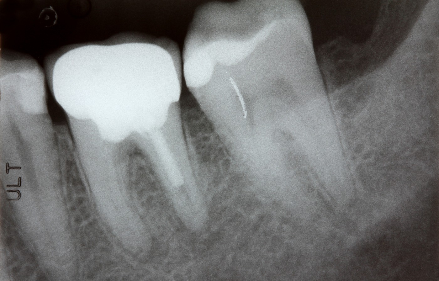 Radiografie retroalveolară digitalo performantă - YTS-Dental View