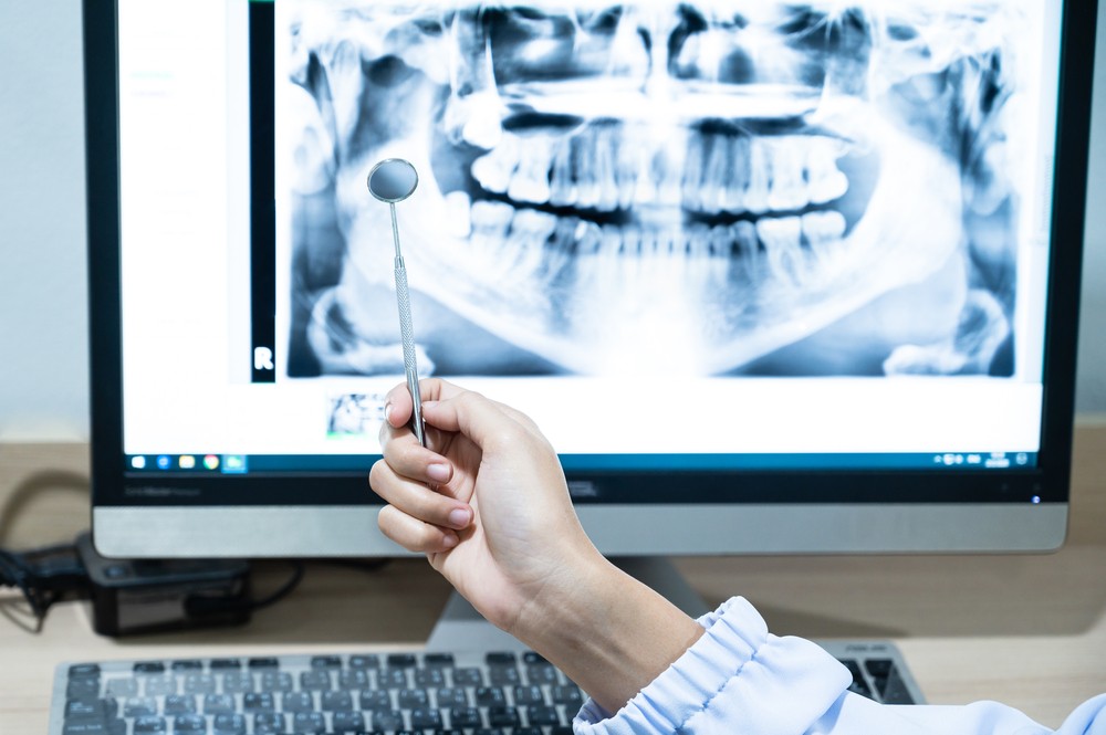 tomografii dentare, CBCT