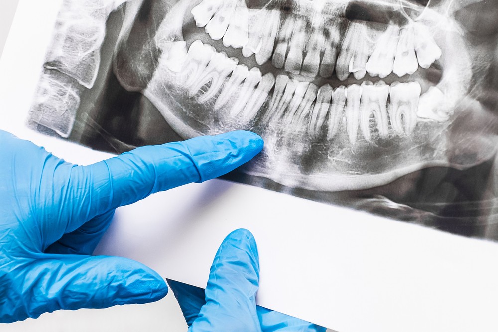 tomografie dentara, radiologie dentara, yts dental view